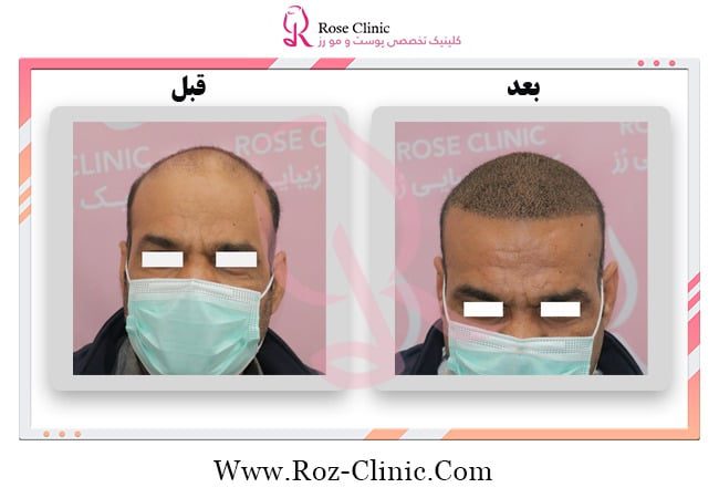 Appropriate hair transplant method in Rose Clinic