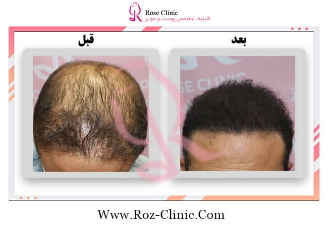High density hair transplant in Rose Clinic