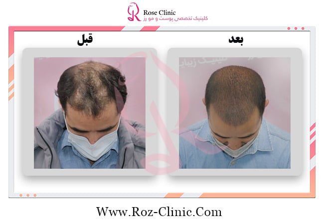 How many times can a hair transplant be done