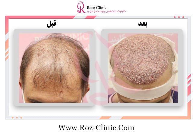 Natural and dense hair transplant samples in Rose Clinic