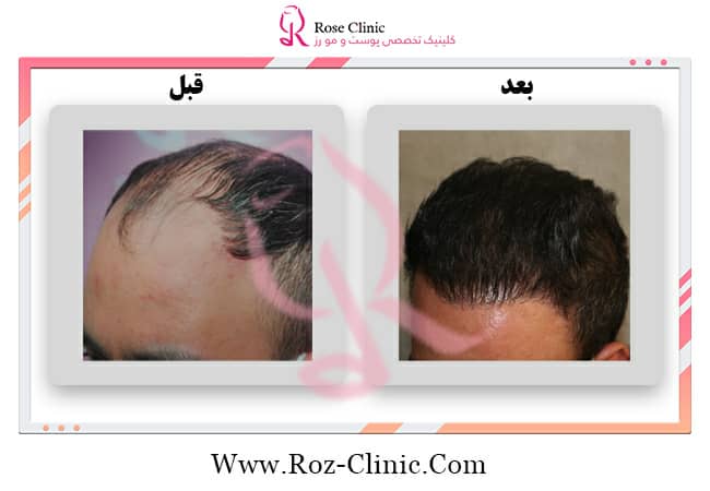Photo of hair transplant after 6 months in Rose Clinic
