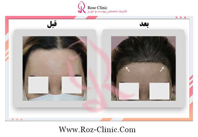 Photo of natural hair transplantation with the highest density