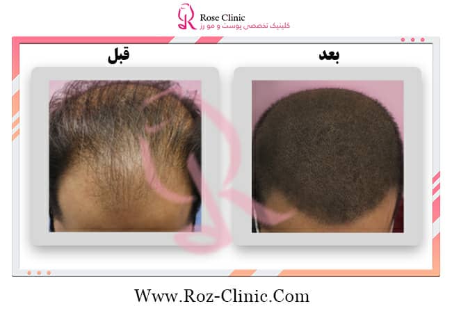 Photo of the best hair transplant result by Dr Reza Rouhani