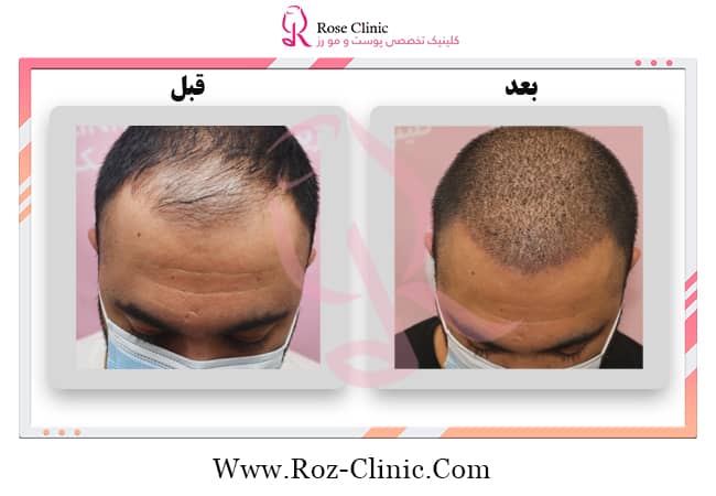 Pictures of hair transplant operation