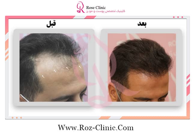 Real image of hair transplant after 1 year